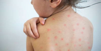 The back of a child, covered in red spots