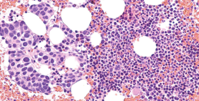 Bone marrow infected with metastatic breast cancer tumor cells.