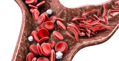 Image of blood cells, some are normal, and others are sickle-shaped and causing a blockage.