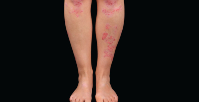 A person's legs with psoriasis patches.