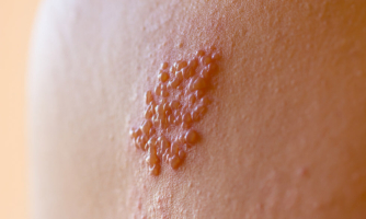 Shingles is a painful rash on the skin that comes from the same virus that causes chickenpox.